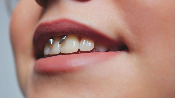 Smiley (Frenulum) Piercing